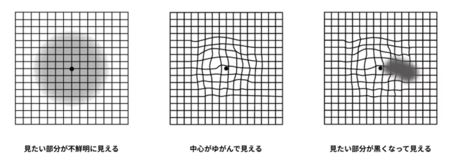 黄斑上膜セルフチェック結果